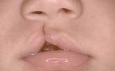 El labio leporino