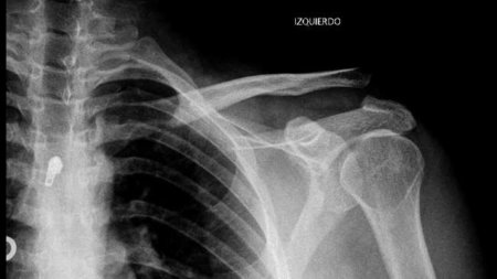 La importancia de anticiparse a la osteoporosis