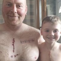 Un padre se tatúa la misma cicatriz de su hijo, operado del corazón, para demostrarle que no hay que avergonzarse