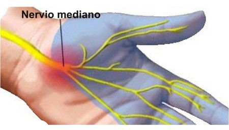Sindrome Tunel Carpiano