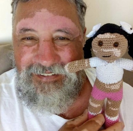 Vitilinda, la muñeca con manchas en la piel que un abuelo tejió para arrancar una sonrisa a su nieta con vitíligo