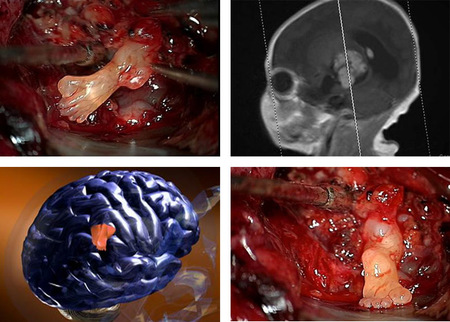 Bebé con un pie en el cerebro