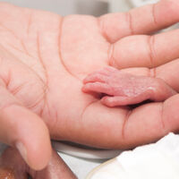 La bebé más prematura del
mundo, que pesó 212 gramos al nacer, recibió el alta tras un año hospitalizada