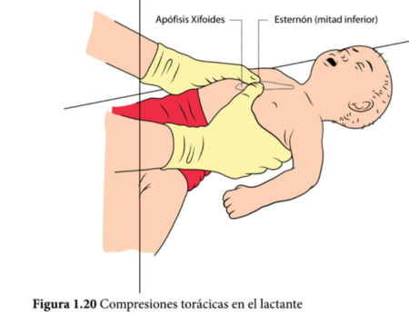 Lactante-Compresiones