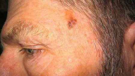 El cáncer de piel ha aumentado hasta en un 237 por ciento