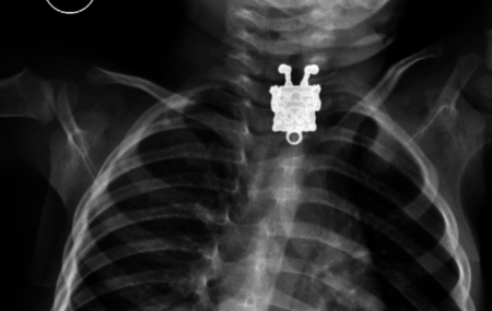 Por qué los niños no deben jugar con objetos pequeños: Bob Esponja hallado en el esófago de un niño