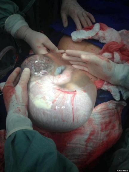 Impresionante: la foto del bebé que nació con el saco amniótico intacto