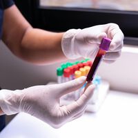 O fim do diagnóstico tardio: a nova invenção brasileira que identifica o câncer de mama logo no início apenas pelo sangue 