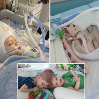 Separan con éxito a dos bebés que nacieron unidos por la cabeza 