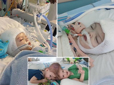 Separan con éxito a dos bebés que nacieron unidos por la cabeza 