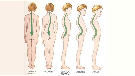 escoliosis-cifosis