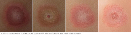 Enfermedad De Lyme Diana