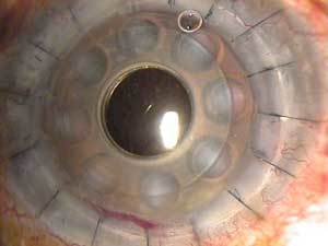 Implantes de córneas artificiales