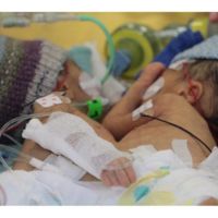 Las siamesas más jóvenes en ser separadas a los ocho días de vida