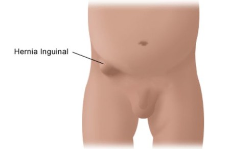 hernia inguinal