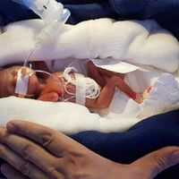 Llegó al mundo con 400 gramos y logró sobrevivir pese a haber nacido niña en la India