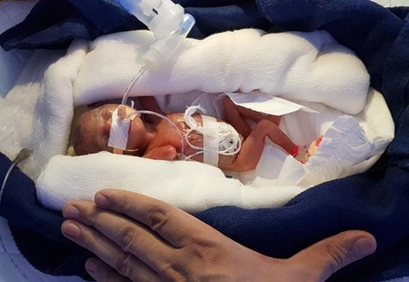Llegó al mundo con 400 gramos y logró sobrevivir pese a haber nacido niña en la India