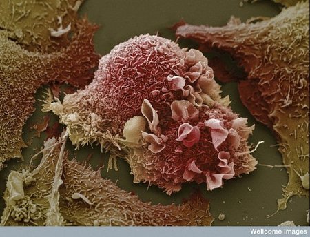 Creada una nanopartícula que utiliza la luz y el calor para destruir tumores