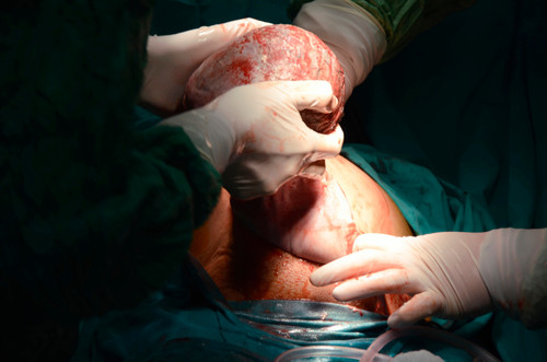 ¿Por qué no juzgan a los ginecólogos de drogar a las mujeres con oxitocina para que los partos acaben en cesárea?