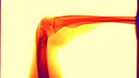 Las fracturas de osteoporosis se triplicarán en los próximos 50 años