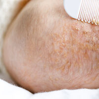 Costra láctea en el cuero cabelludo del recién nacido: ¿hay que quitarla? ¿cómo se trata? 