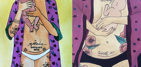 Las bellas pinturas que nos muestran lo especial que es el parto por cesárea