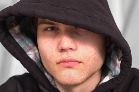 Acne Adolescente