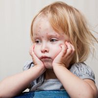 Varicela en bebés y niños: cuáles son los síntomas de alerta y cómo prevenirla
