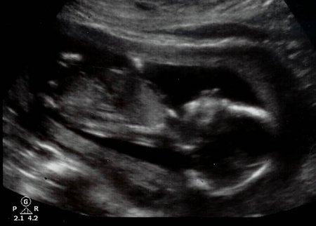 Una pareja hace una encuesta online para decidir si parir o abortar