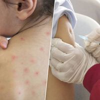 México llevaba décadas "libre sarampión". La crisis de Jalisco y el desplome de las vacunaciones están a punto de cambiarlo