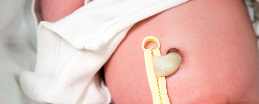 Cordon Umbilical Cuales Son Los Signos De Alarma Que Debemos Vigilar