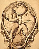 La vuelta de cordón umbilical en el cuello del feto