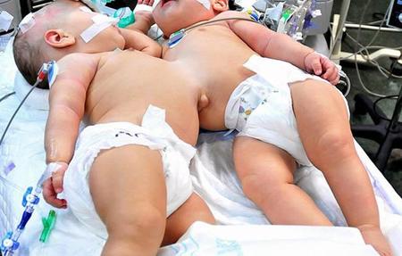 siamesas-Marta-Nuria