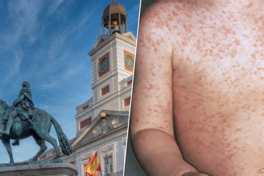 Madrid suma más casos de sarampión en un mes y medio que en todo 2025: la alerta por transmisión comunitaria ya es real