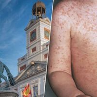 El problema no es que Madrid ya tenga más casos de sarampión que en todo 2025: es cómo ha empezado el brote