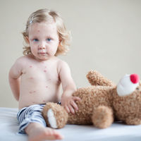 Unicef alerta: 21,1 millones de niños no se vacunaron contra el sarampión en los últimos ocho años