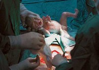 En las clínicas privadas de Barcelona se practica el doble de cesáreas que en las públicas  