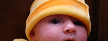 Diez alteraciones en la piel del recién nacido