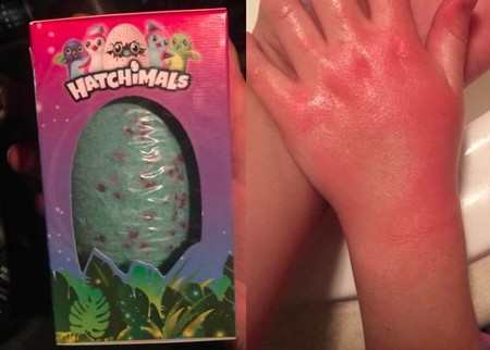 Una madre advierte sobre las quemaduras en las manos de su hija producidas supuestamente por una bomba de baño Hatchimals