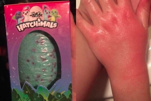 Una madre advierte sobre las quemaduras en las manos de su hija producidas supuestamente por una bomba de baño Hatchimals 