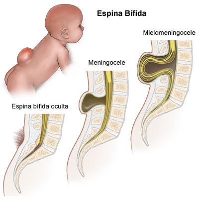 espina-bifida-cirugia-fetal