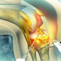 Médico brasileiro desenvolveu uma técnica que pode salvar joelhos no mundo todo ao preservar o menisco e prevenir artrose 