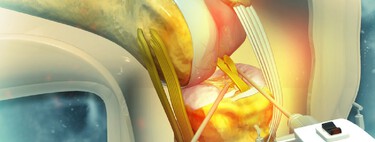 Médico brasileiro desenvolveu uma técnica que pode salvar joelhos no mundo todo ao preservar o menisco e prevenir artrose 