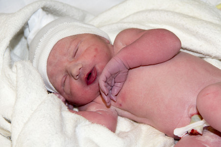 riesgos de hipoglucemia neonatal