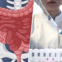El cáncer de colon ya no es cosa de mayores: los casos en jóvenes se disparan y la ciencia apunta a nuestro estilo de vida