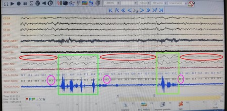 Explicacion Polisomnograma