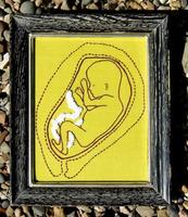 Eutanasia a bebés con espina bífida, ¿una práctica aceptable?