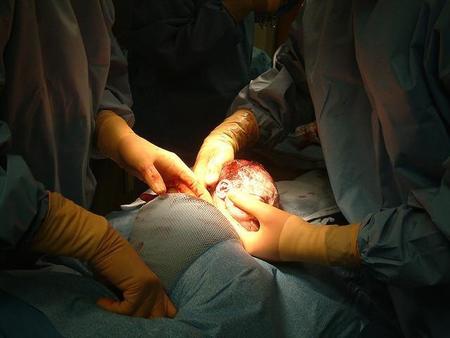 Nacer por cesárea relacionado con mayor riesgo de obesidad en la adultez