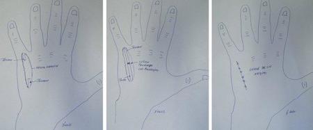 Evolucion dedo Nico Terol