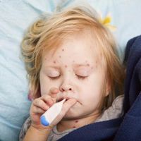 Un niño con leucemia muere en Italia contagiado de sarampión por sus hermanos, que no estaban vacunados 